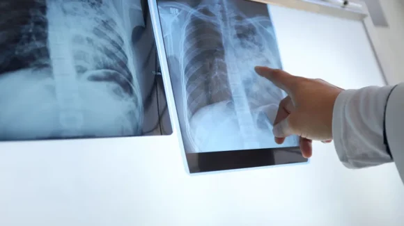 Argentina registra aumento en casos de tuberculosis durante 2026