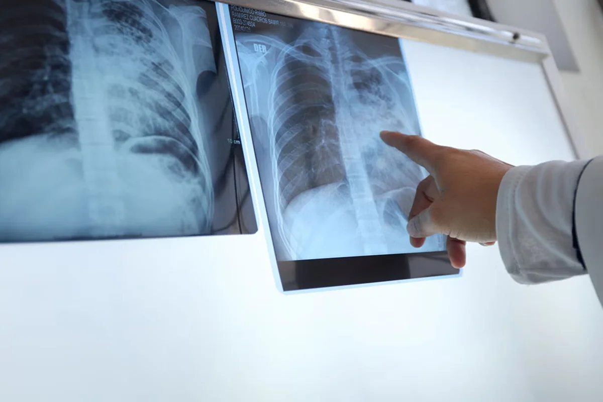 Tuberculosis Argentina