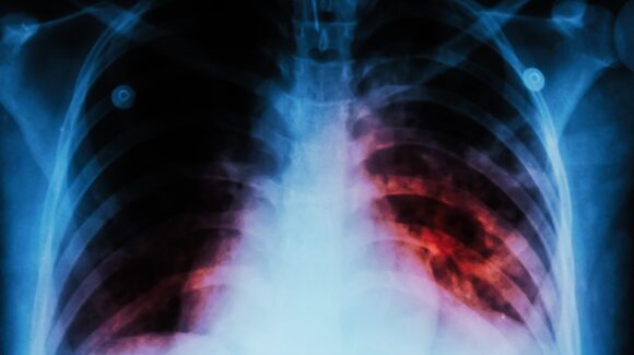 Piden en el Congreso de Nuevo León reforzar el seguimiento de tratamientos contra la tuberculosis para evitar cepas resistentes
