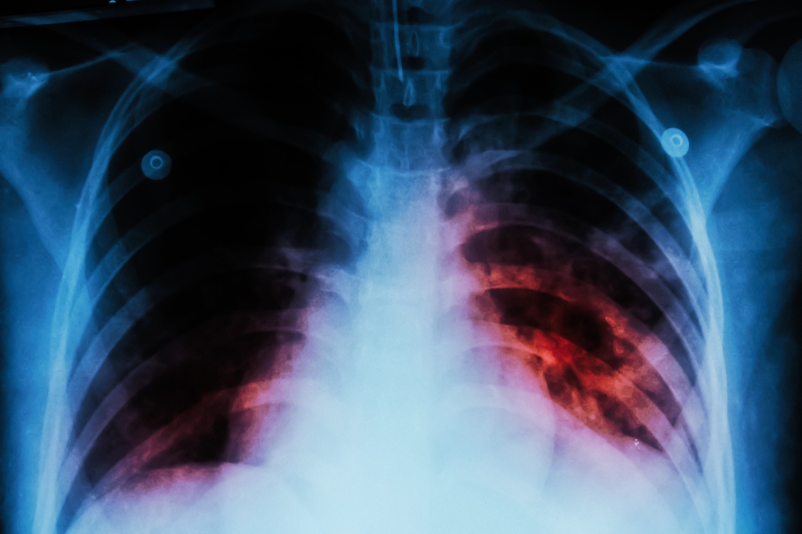 Piden en el Congreso de Nuevo León reforzar el seguimiento de tratamientos contra la tuberculosis para evitar cepas resistentes